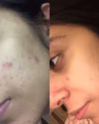 Skin Brightening Serum Glutathione 2% Alpha Arbutin 2% Kojic Acid Dipalmitate 2% Niacinamide 5%